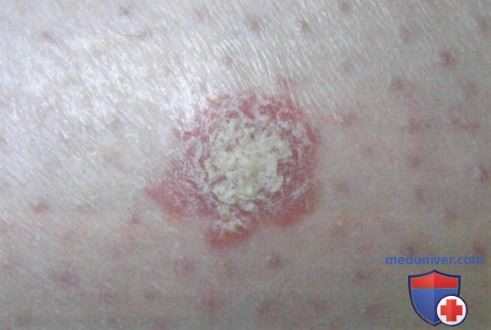 Актинический кератоз и болезнь Боуэна