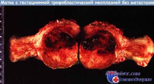 Матка с гестационной трофобластической неоплазией