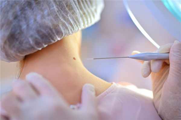 плоскоклеточный рак кожи