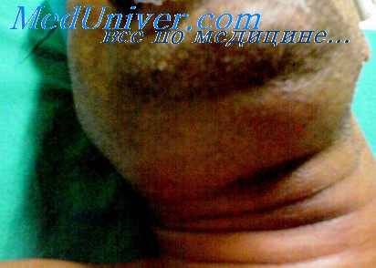 инфекционный мононуклеоз