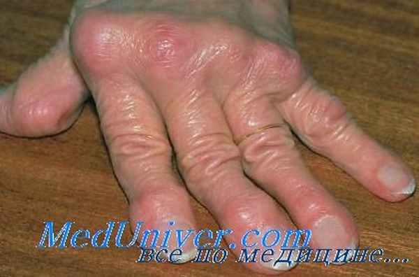 лечение ревматоидного артрита