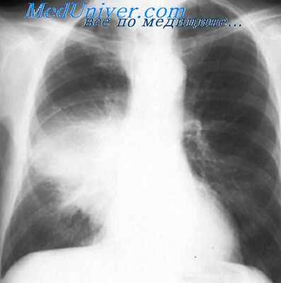 легионеллезная пневмония