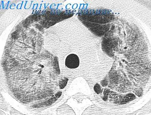 эозинофилия при гельминтозе