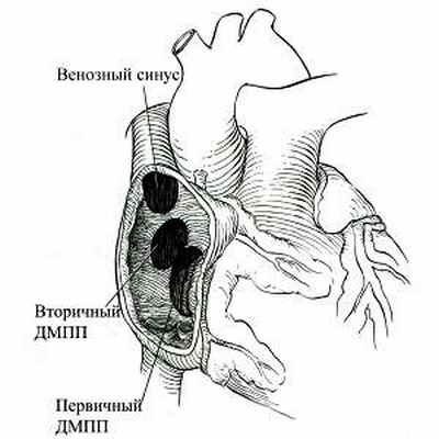 Схема локализации дефектов межпредсердной перегородки