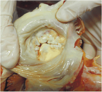 Митральный стеноз, вид на предсердную поверхность митрального клапана (наблюдение врача Е.А. Степановой, ГБУЗ ГКБ им. В.М. Буянова ДЗМ)
