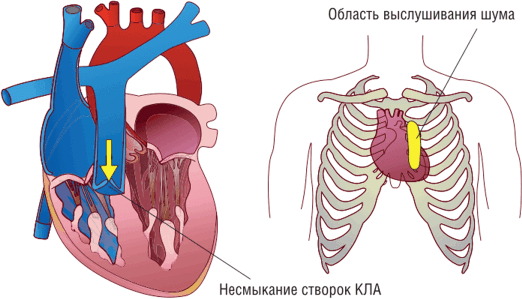 Шум Грехема—Стилла (Graham—Steell) — шум относительной недостаточности КЛА