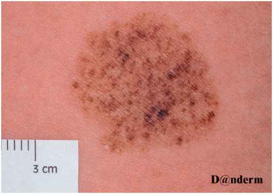 Пятнистый невус