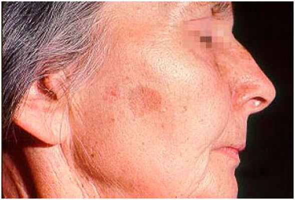 Очаг солнечного лентиго на щеке женщины