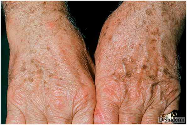 Солнечное (старческое) лентиго на возрастной коже рук