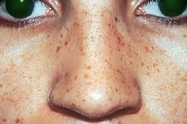 простое или юношеское лентиго