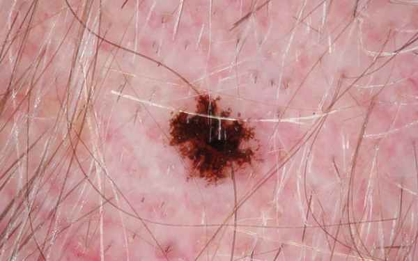 Лентиго в виде чернильных пятен