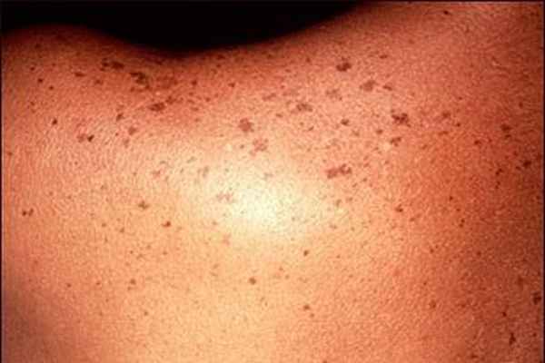 солнечное лентиго