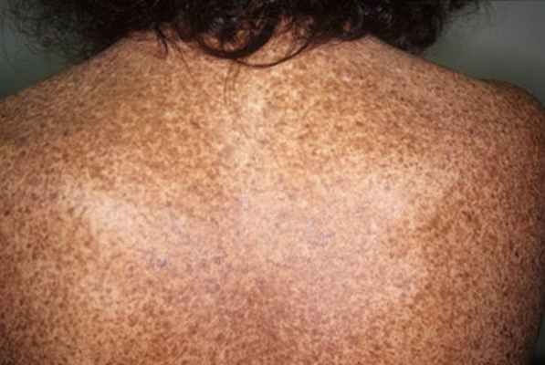 Синдром L.E.O.P.A.R.D