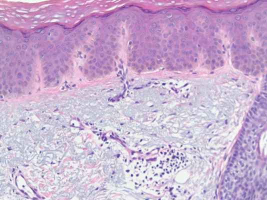 простое лентиго