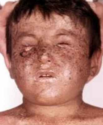 Пигментная ксеродерма