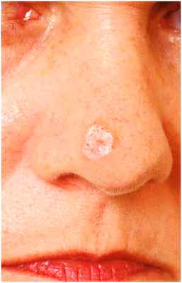 Десмопластическая меланома