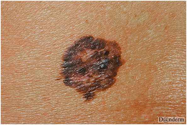 Поверхностно распространяющаяся меланома