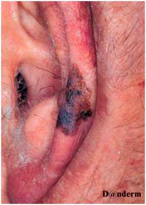 Меланома - злокачественное лентиго