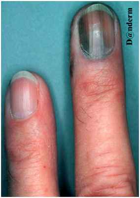 Акральная лентигиозная меланома под ногтем