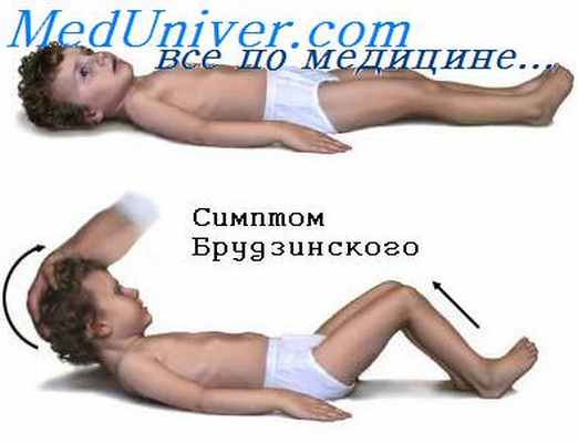 лептоспирозный менингит