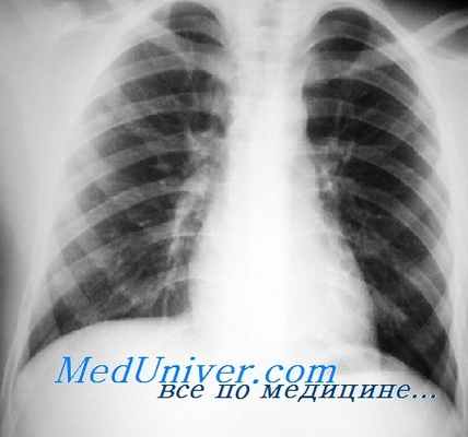 левые отделы сердца на рентгенограмме