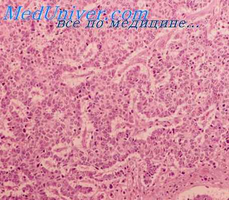 рак шейки матки