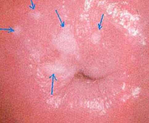 Кольпоскопия при лейкоплакии шейки матки