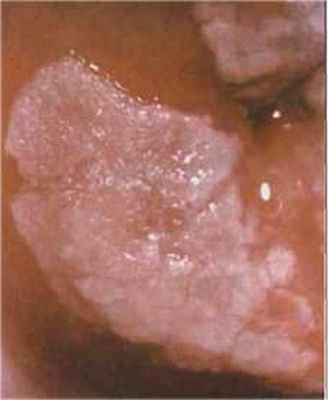 На снимке - фото лейкоплакии шейки матки