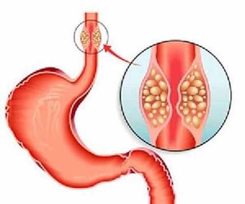 Леомисаркома