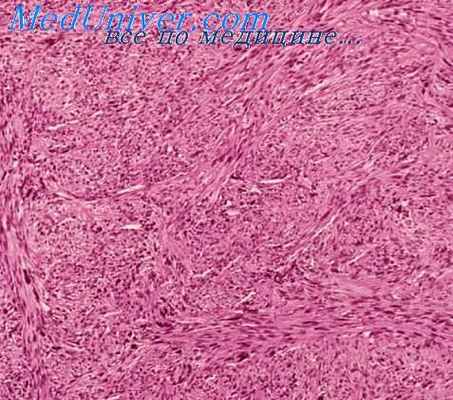 лейомиосаркома