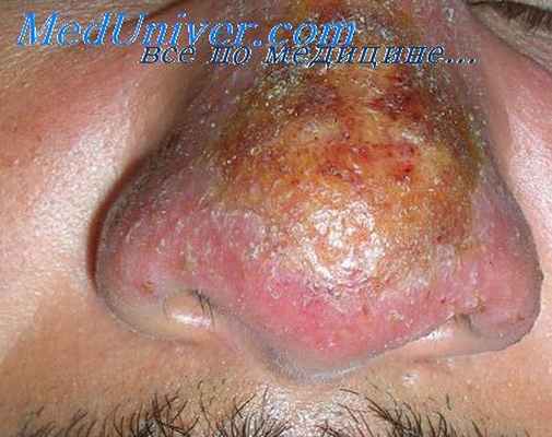 лейшманиоз в судане