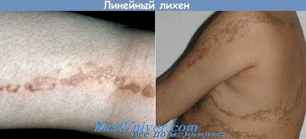 линейный лихен