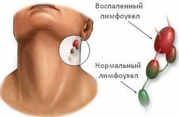 Лечение лимфаденита «Оксфорд Медикал»