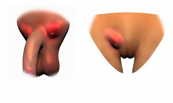 увеличенные лимфоузлы в паху при сифилисе