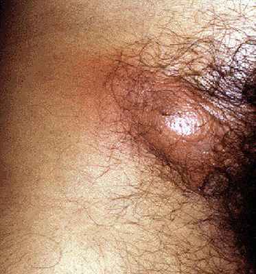 болезненный лимфоузел в паху при сифилисе