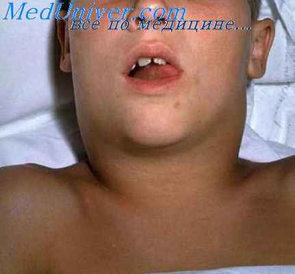 лимфаденит