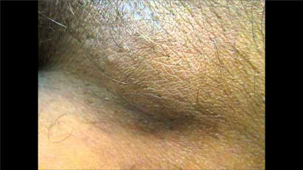 увеличенные лимфоузлы в паху