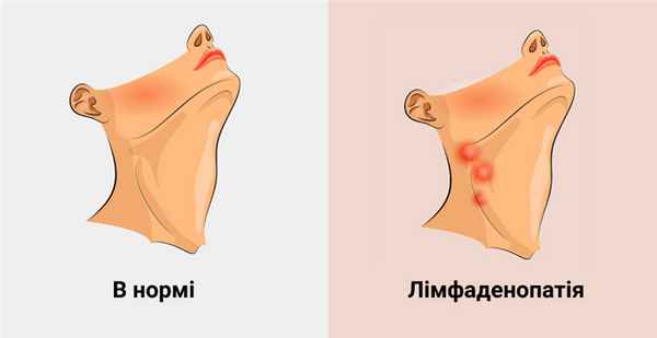 Патогенез лимфоденопатии