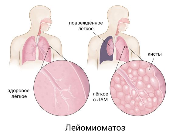 Лейомиоматоз [20]