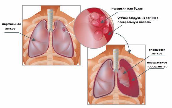 Пневмоторакс