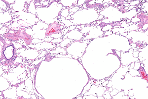 Лимфангиолейомиоматоз