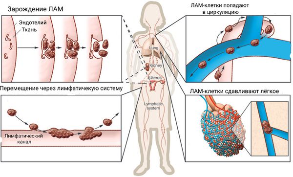 Распространение ЛАМ [21]
