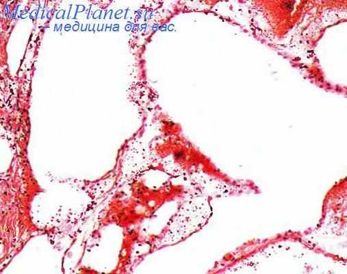 Кавернозная лимфангиома