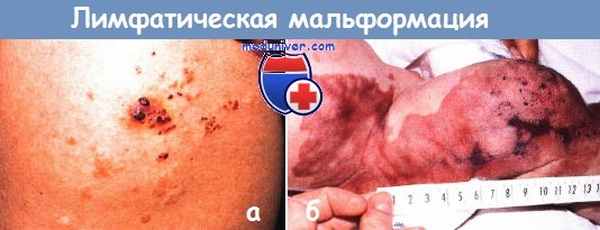 Лимфатическая мальформация у новорожденного