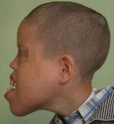 лимфатическая мальформации средней и нижней частей лица сбоку