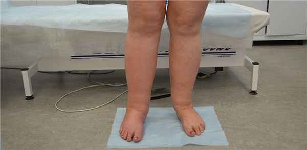 Лечение лимфедемы нижних конечностей