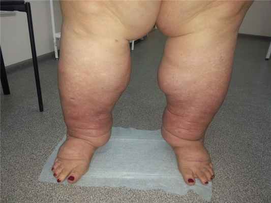 Лечение лимфедемы