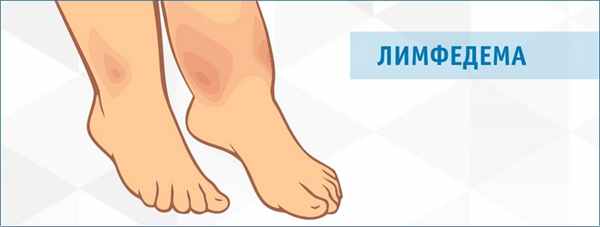 Лимфедема