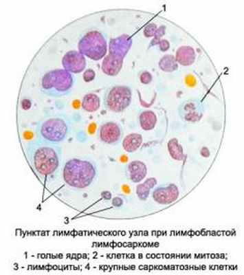 Лимфобластная лимфома 