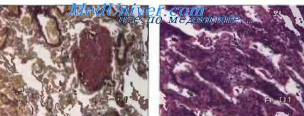 аллергический альвеолит